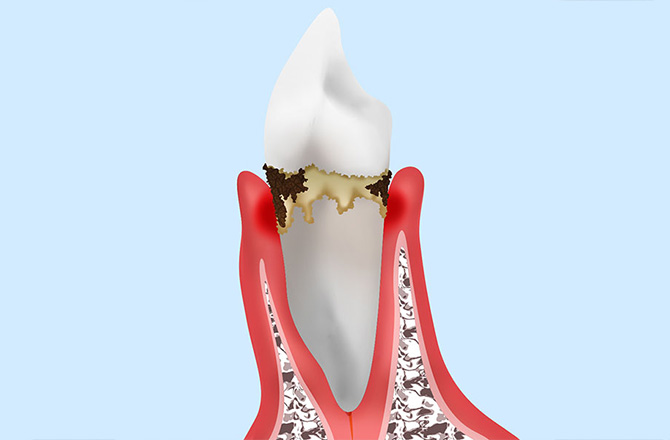 軽度の歯周炎